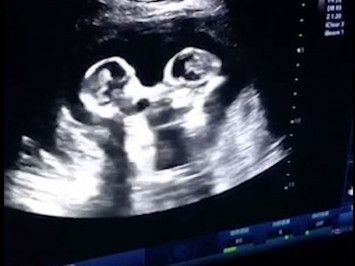 Waduh! Masih Ada di Dalam Kandungan, Dua Bayi Kembar Sudah Adu Pukul