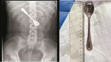 sendok tertelan kedalam perut wanita karena ingin mengeluarkan tulang ikan