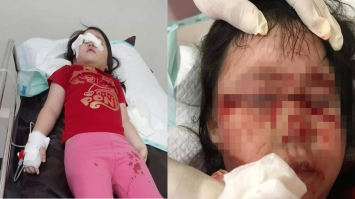 balita terluka akibat tali layangan