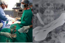 isi perut pria ini obeng hingga pisau