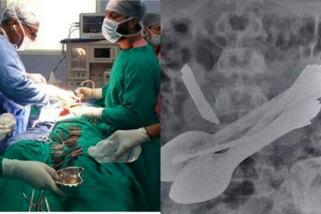 isi perut pria ini obeng hingga pisau