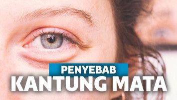 Penyebab kantung mata