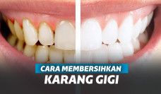 cara membersihkan karang gigi 1