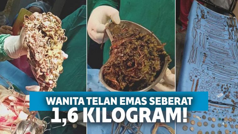 Telan Emas Seberat 1 6 Kg Isi Perut Wanita Mengerikan