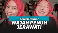 Cewek nggak malu dengan jerawatnya