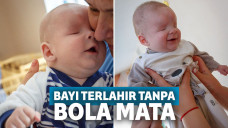 Ibu Tolak Mengasuh, Bayi Terlahir Tanpa Bola Mata Ini Cari Orangtua yang Mau Merawatnya