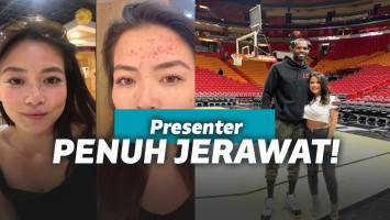 Presenter TV jerawatan