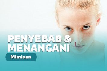 cara mengatasi mimisan