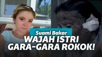 Wajah istri dibakar suami