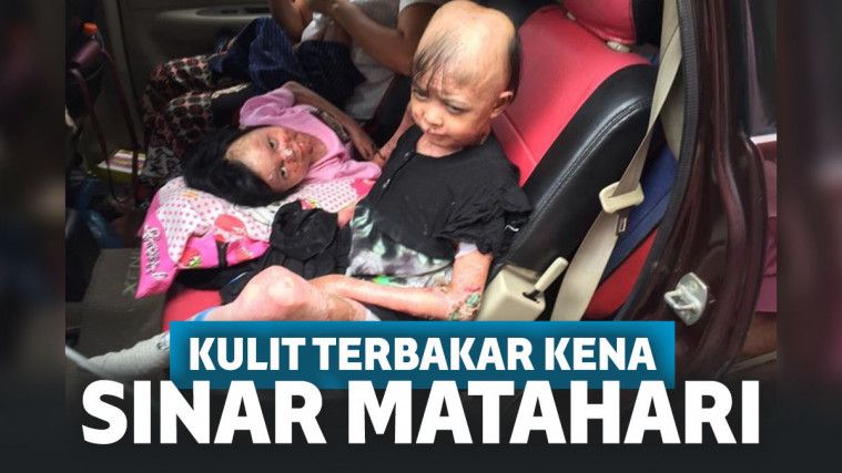 Sedih! Derita Penyakit Ini, Kulit Kakak Beradik Terbakar saat Terkena Sinar Matahari