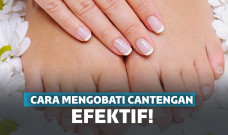 Cara mengobati cantengan