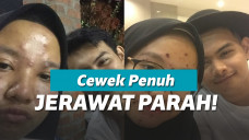 Setia kepada pacar meski jerawatan