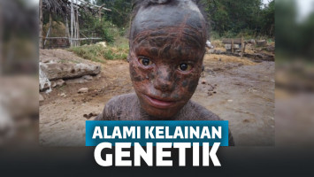 Ini Dia si Manusia Ular, Berganti Kulit Setiap Bulan dan Mandi Setiap Jam