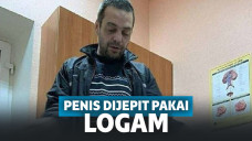 Ngilu! Dituduh Selingkuh, Penis Pria Ini Dipasangin Penjepit Logam oleh Istrinya hingga Bengkak