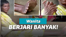 Wanita yang kelebihan jari