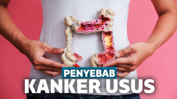 Penyebab Kanker Usus