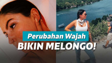 Perubahan wajah wanita yang dulu alami luka bakar