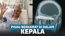 Bikin Ngilu! Seorang Pria Hidup Selama 26 Tahun dengan Pisau Berkarat di Dalam Kepalanya