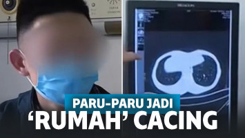 Gemar Masakan Eksotik, Paru-paru Pria Ini Terinfeksi oleh Banyak Cacing