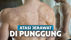 jerawat punggung