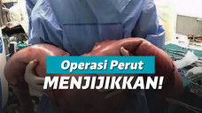 Feses Seberat 13 Kg di Dalam Perut Pria