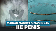Dokter mengangkat 53 bola-bola magnet dari dalam penis sang anak.