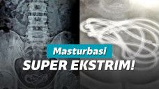 Kabel tersangkut dalam kandung kemih pria 30 tahun