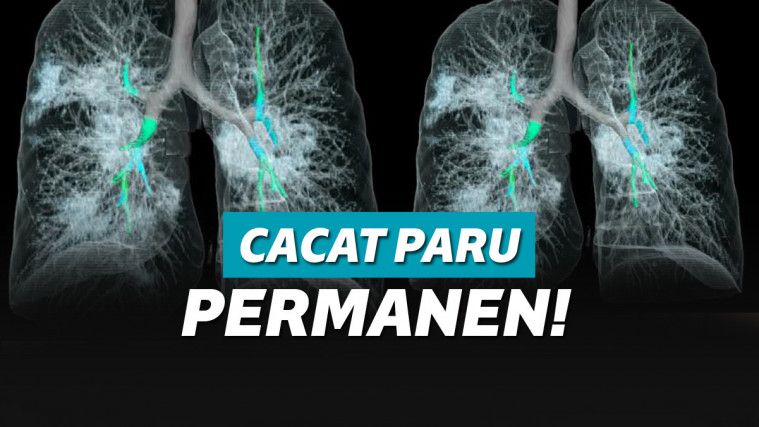 ilustrasi paru-paru terinfeksi corona