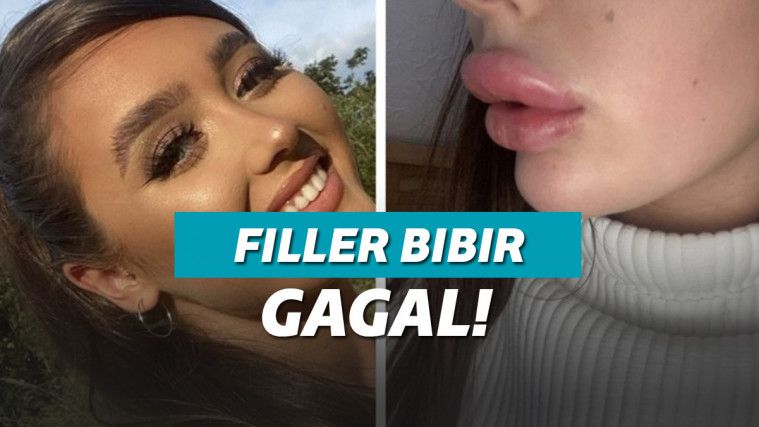 Olivia McCann (21) melakukan filler bibir yang malah membuat bibirnya membengkak
