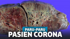 Paru-paru penderita corona