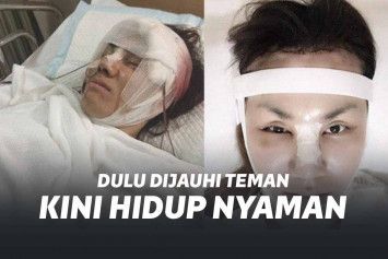 Proses operasi plastik Bow