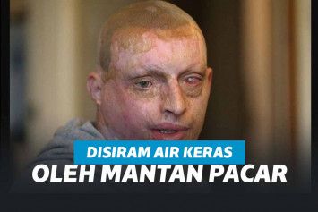 Daniel Rotariu, korban siraman air keras oleh mantan kekasih.