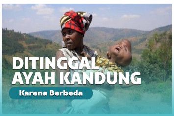 Anak yang dilahirkan berbeda ini ditinggalkan oleh sang ayah