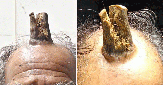 Tanduk tumbuh di kepala