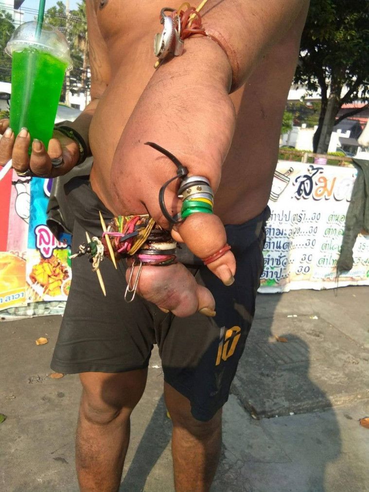 Mengerikan! Pakai Cincin Terlalu Banyak, Jari Pria Ini Jadi Bengkak hingga Membusuk
