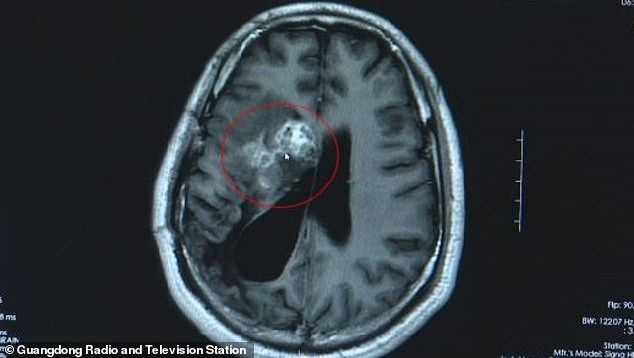 Ngeri! Dikira Kena Tumor Ganas, Ternyata Otak Pria Ini Digerogoti Cacing Pita Sepanjang 12 Cm