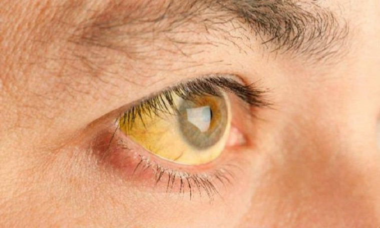 hepatitis A