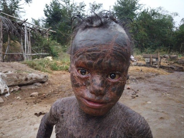 Ini Dia si Manusia Ular, Berganti Kulit Setiap Bulan dan Mandi Setiap Jam
