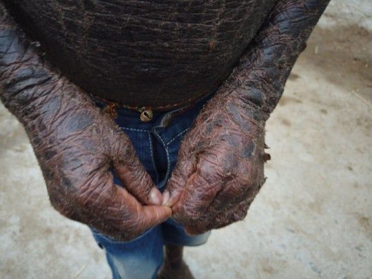 Ini Dia si Manusia Ular, Berganti Kulit Setiap Bulan dan Mandi Setiap Jam