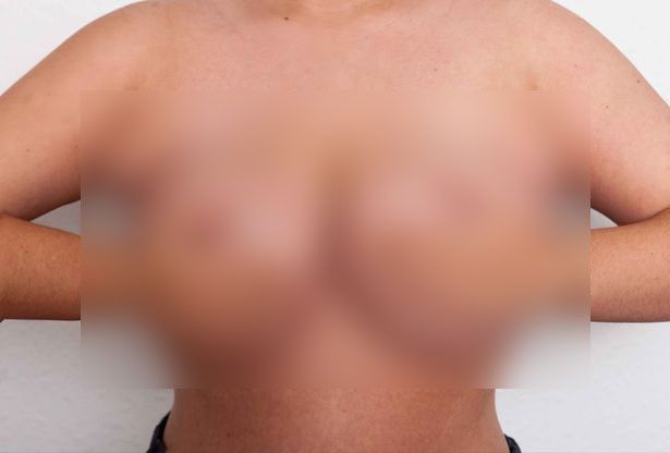 Tak Percaya Diri Punya 4 Payudara, Wanita Ini Akhrinya Jalani Operasi Pengangkatan