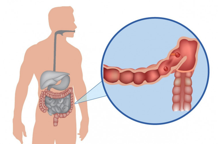 Penyebab Kanker Usus Gejala Dan Cara Mencegahnya