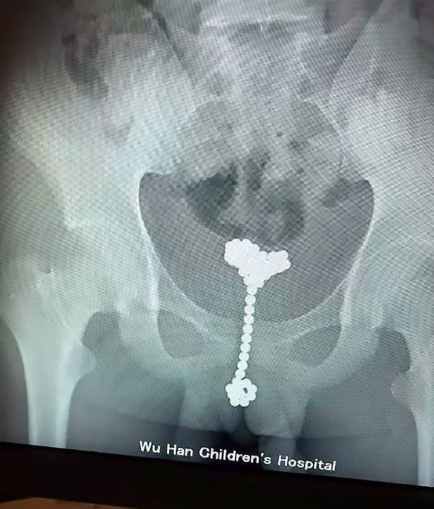 Dokter mengangkat 53 bola-bola magnet dari dalam penis sang anak.