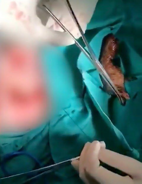 Seekor ikan nila ditemukan dalam organ tubuh pria di China
