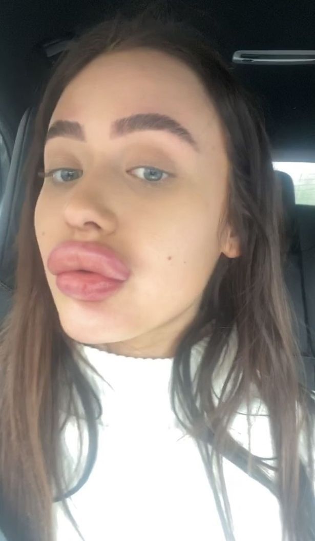 Olivia McCann (21) melakukan filler bibir yang malah membuat bibirnya membengkak
