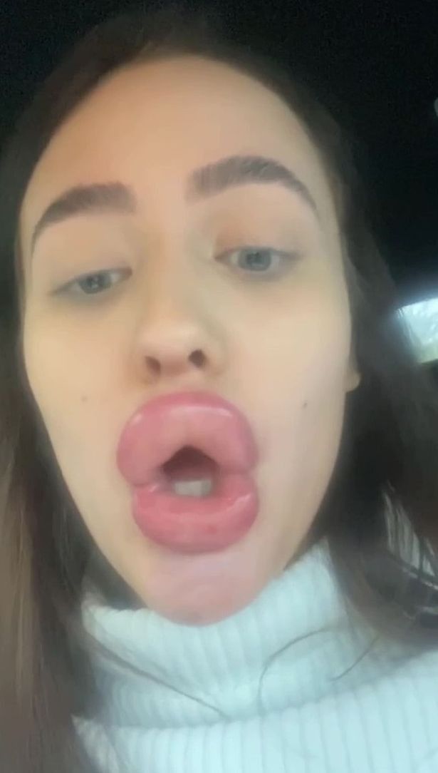 Olivia McCann (21) melakukan filler bibir yang malah membuat bibirnya membengkak