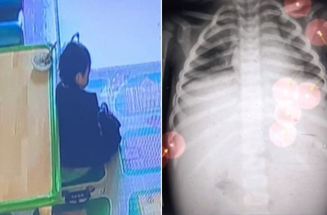 (kiri) foto ketika Jung-In sedang di tinggal sendiri (kanan) kerusakan organ dalam Jung-In