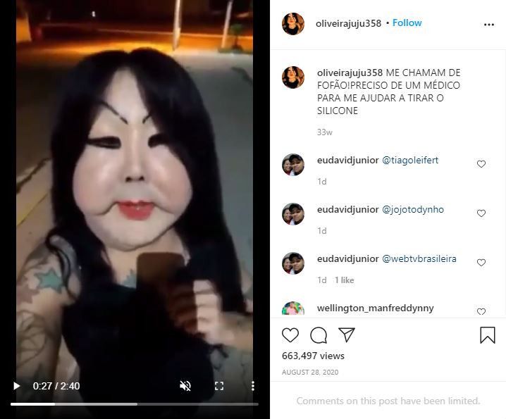 Transgender yang menyuntikkan wajahnya dengan silikon industri